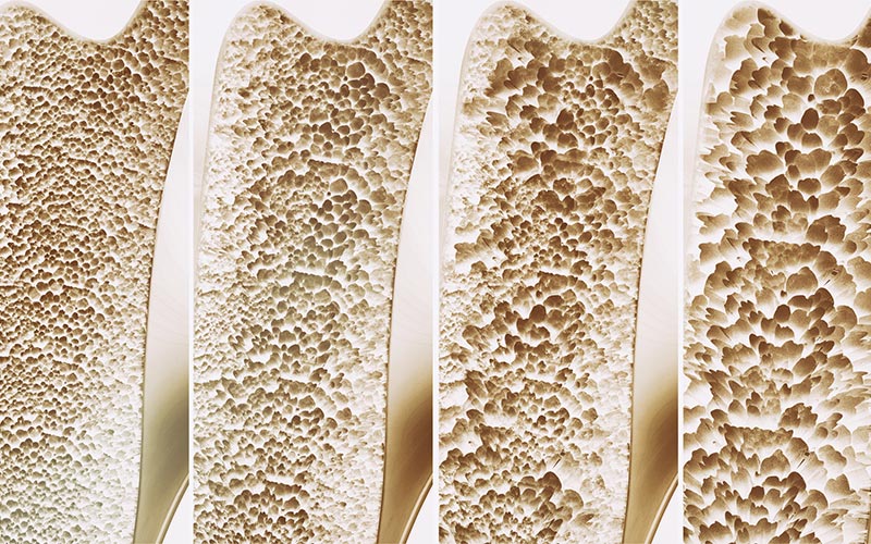 Como a Vitamina D Impacta a Densidade Óssea