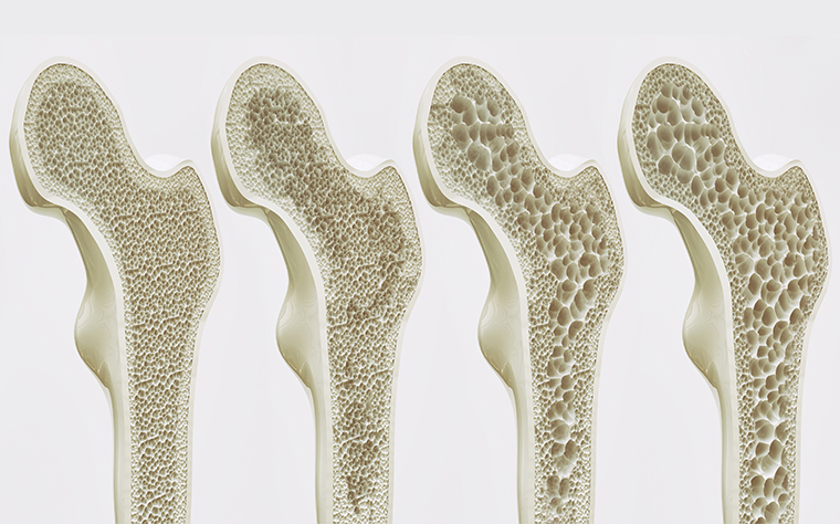 Como aumentar a massa óssea naturalmente