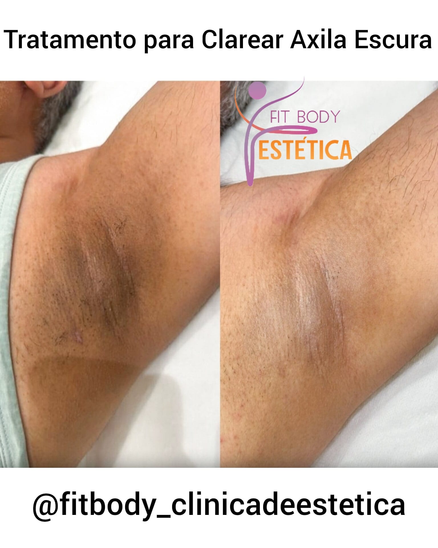 Quando Procurar um Dermatologista para Manchas nas Axilas