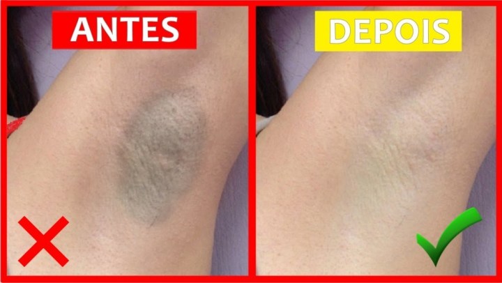 5 Mitos sobre Clareamento de Axilas