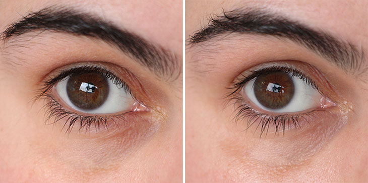 Dicas para potencializar o efeito do pepino nas olheiras