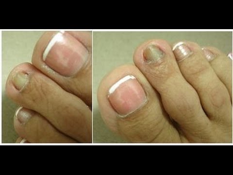 Como clarear as unhas dos pés com bicarbonato