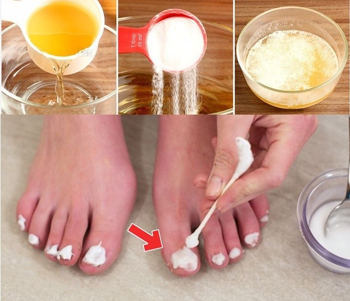 Como clarear as unhas dos pés com bicarbonato