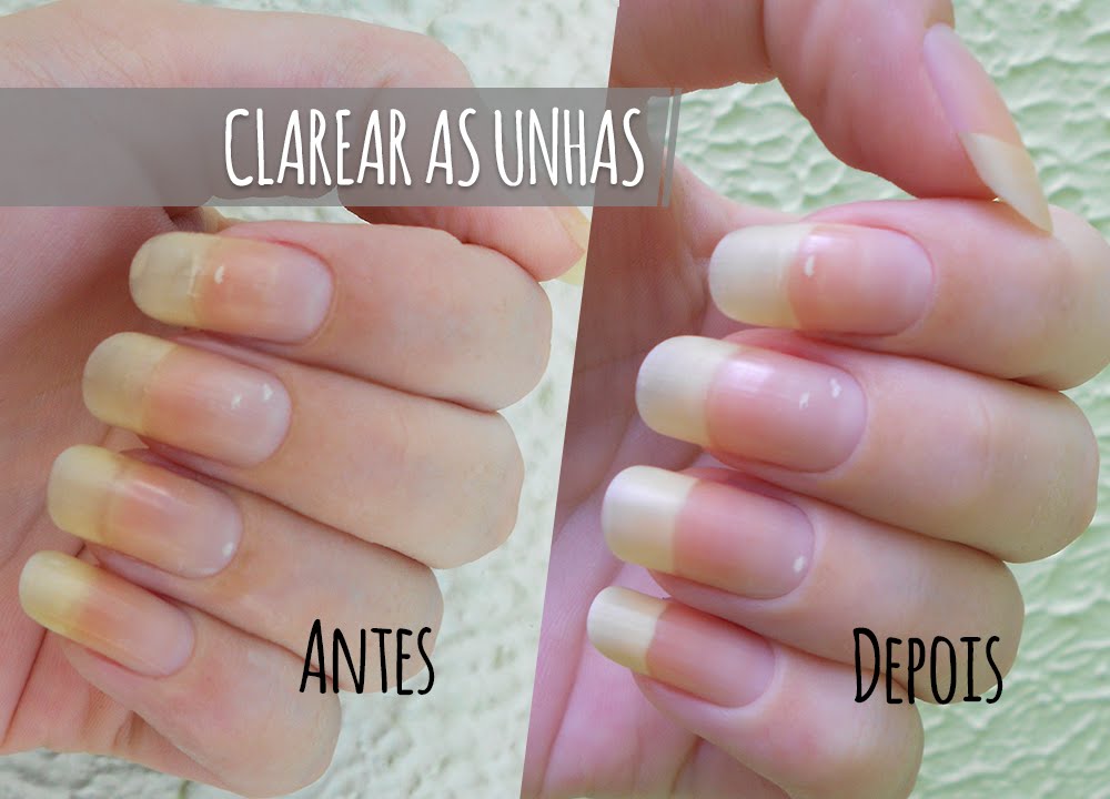 Como clarear as unhas dos pés com bicarbonato