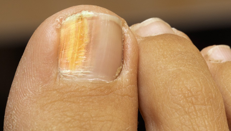 Como identificar fungos nas unhas vs. manchas de esmalte