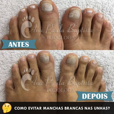 5 Mitos e Verdades sobre Clareamento de Unhas