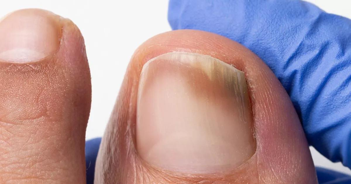 Como clarear as unhas dos pés manchadas