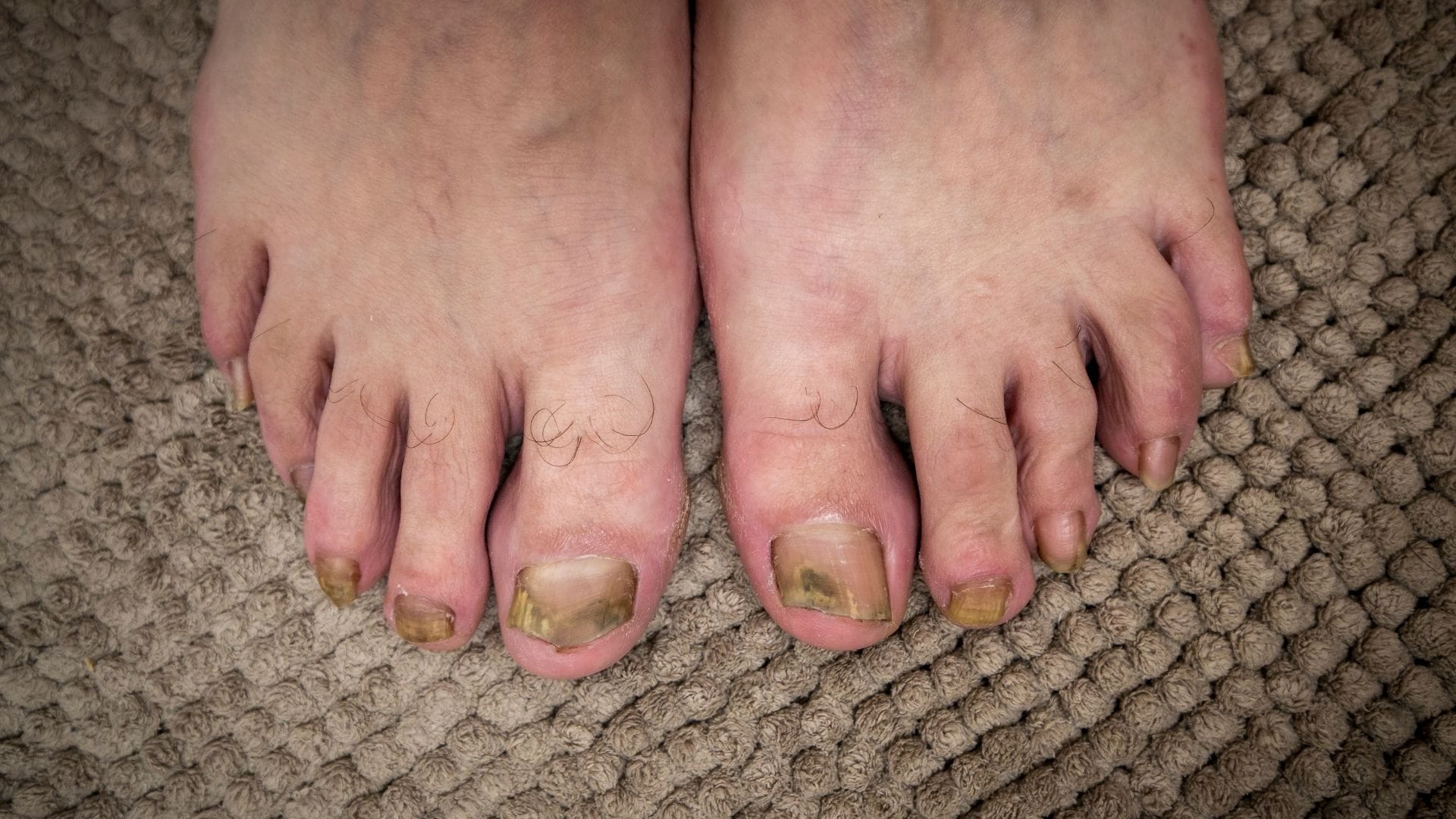 Como clarear as unhas dos pés naturalmente