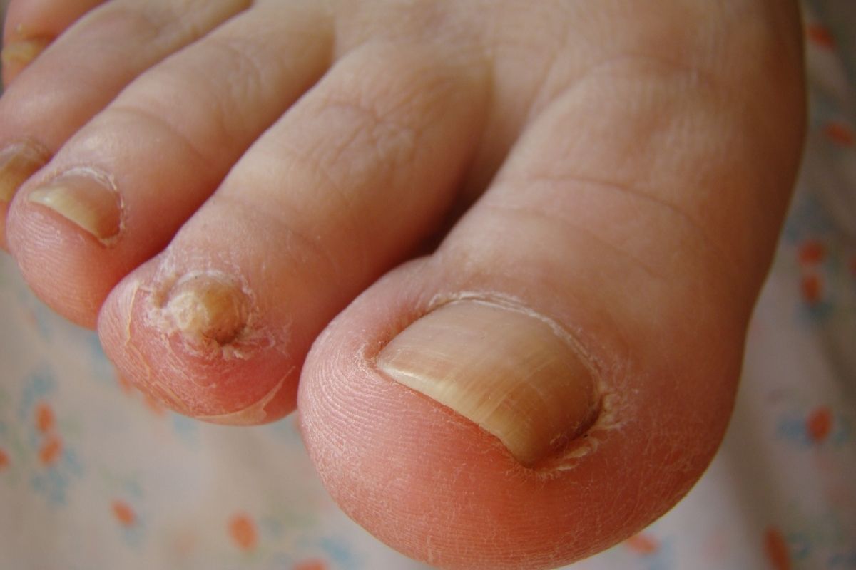 Como Prevenir o Amarelamento das Unhas dos Pés