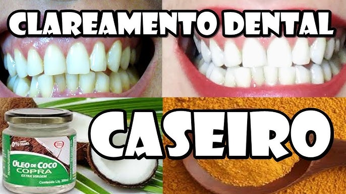 Como clarear os dentes com açafrão e óleo de coco