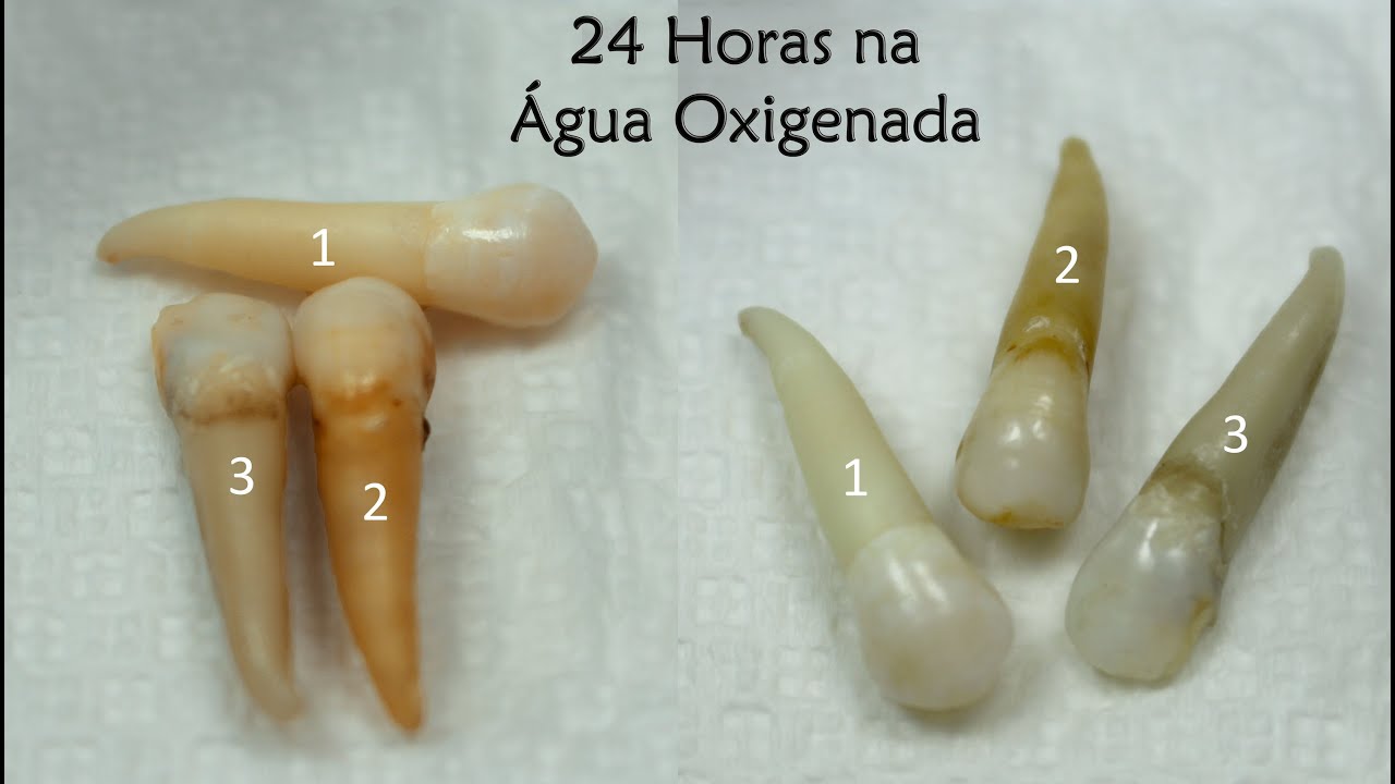 Como clarear os dentes com bicarbonato e água oxigenada