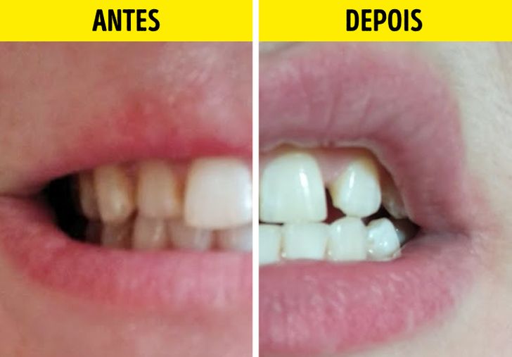 O Que um Dentista Pensa Sobre Receitas Caseiras de Clareamento