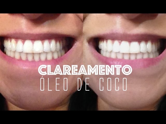 Como clarear os dentes com bicarbonato e óleo de coco