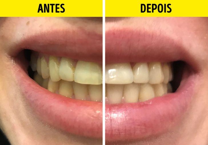 Os Perigos Ocultos do Bicarbonato de Sódio para Seus Dentes
