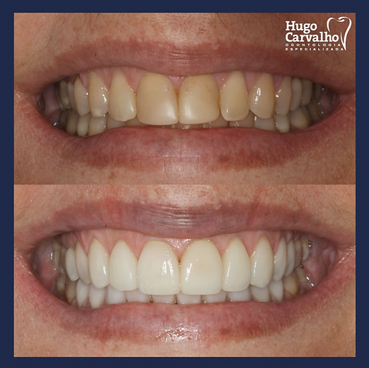 Quando a Substituição de Facetas é Necessária?