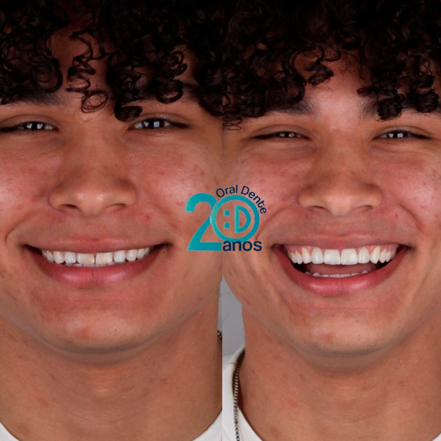 Como clarear os dentes com facetas