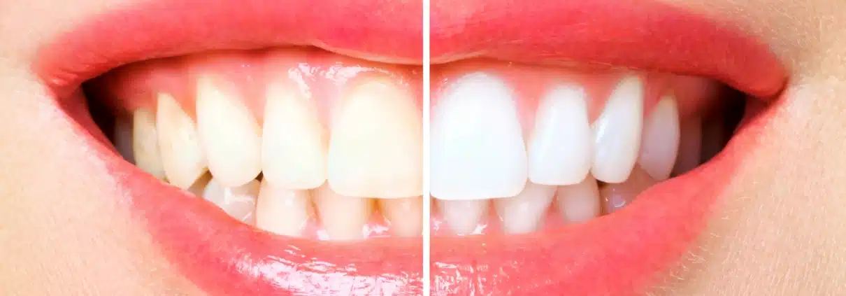 Guia Completo de Clareamento Dental