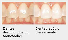 Mitos e Verdades sobre Facetas Dentárias