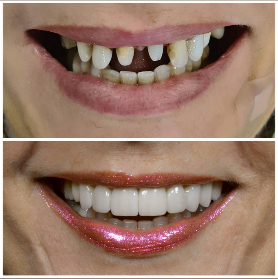 Como clarear os dentes com facetas