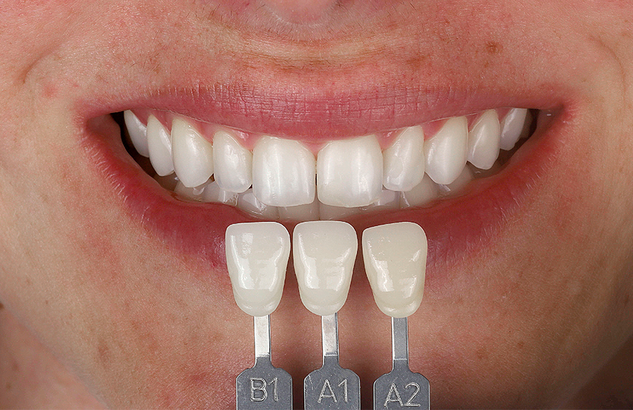Guia Completo de Clareamento Dental