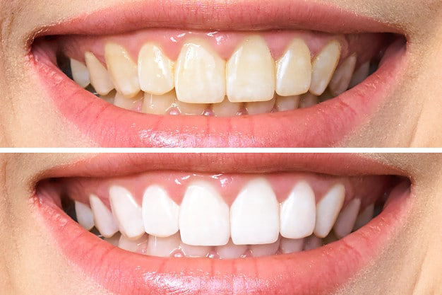 Como Manter o Sorriso Branco Após Procedimentos Estéticos