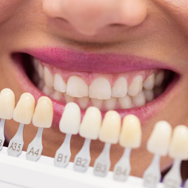 Mitos e Verdades sobre Facetas Dentárias