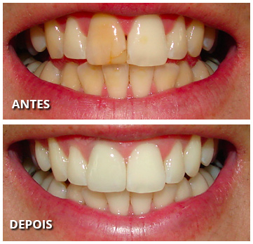 Mitos e Verdades sobre Facetas Dentárias