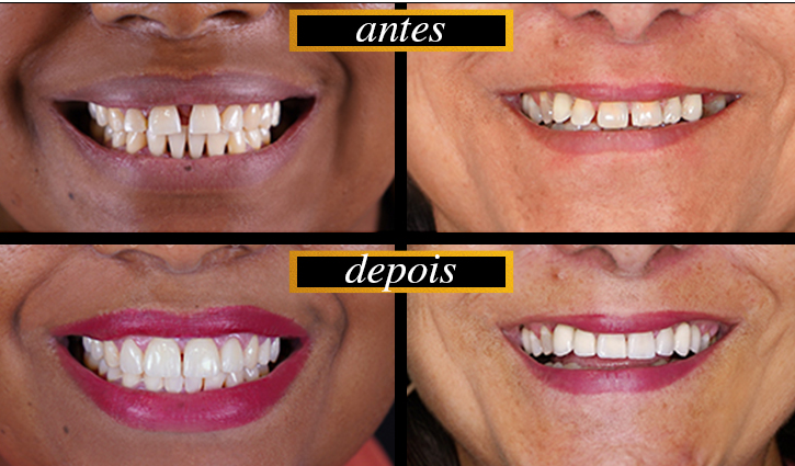 Guia Completo de Clareamento Dental