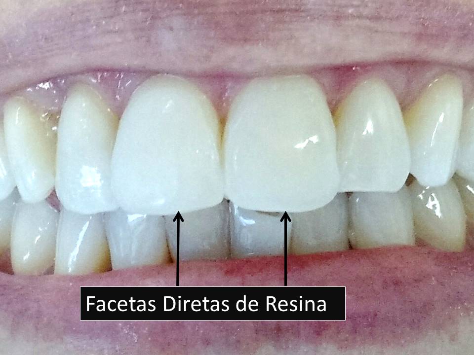 Como Manter o Sorriso Branco Após Procedimentos Estéticos