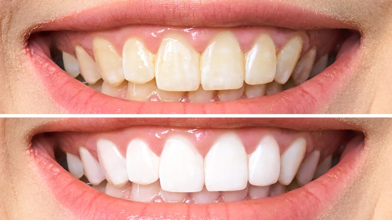 Riscos e Cuidados ao Usar Kits de Clareamento Dental em Casa