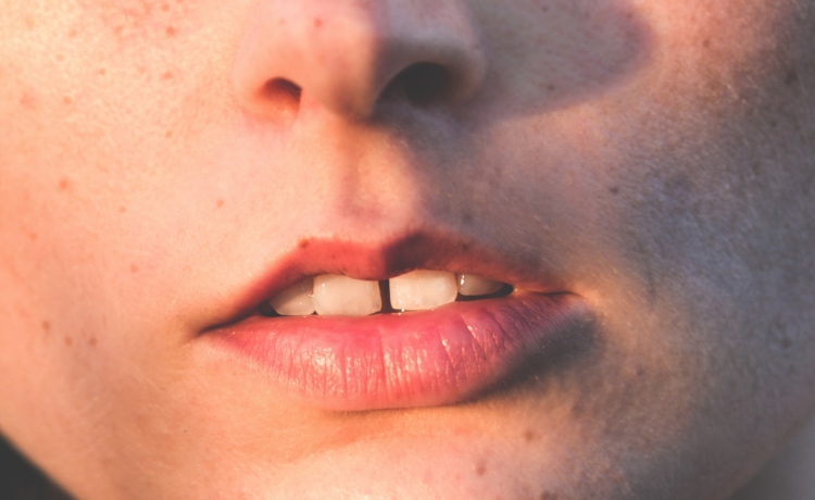 5 Alimentos que Causam Manchas nos Dentes