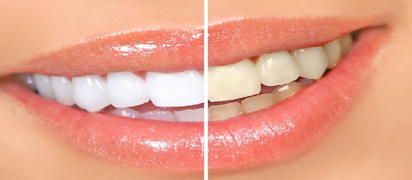 Como Manter o Sorriso Branco Após o Clareamento Profissional