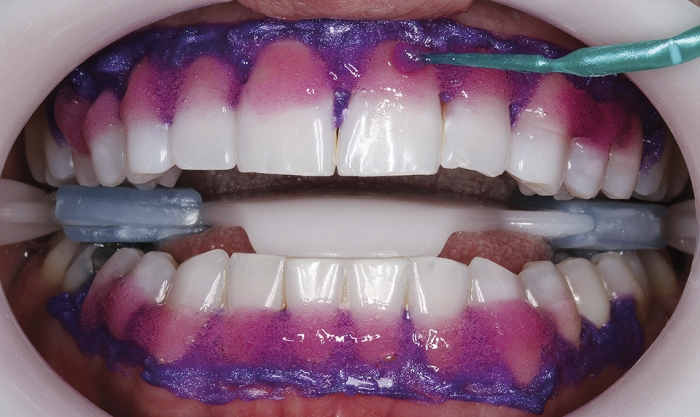 Como clarear os dentes manchados