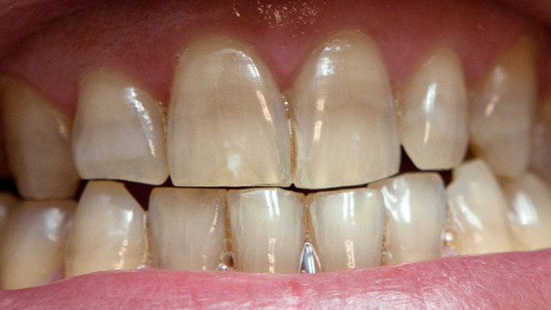 Guia Completo: Clareamento Dental Caseiro vs. Profissional
