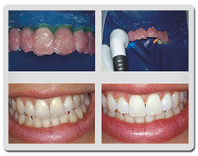 Como Remover Manchas de Café e Vinho dos Dentes