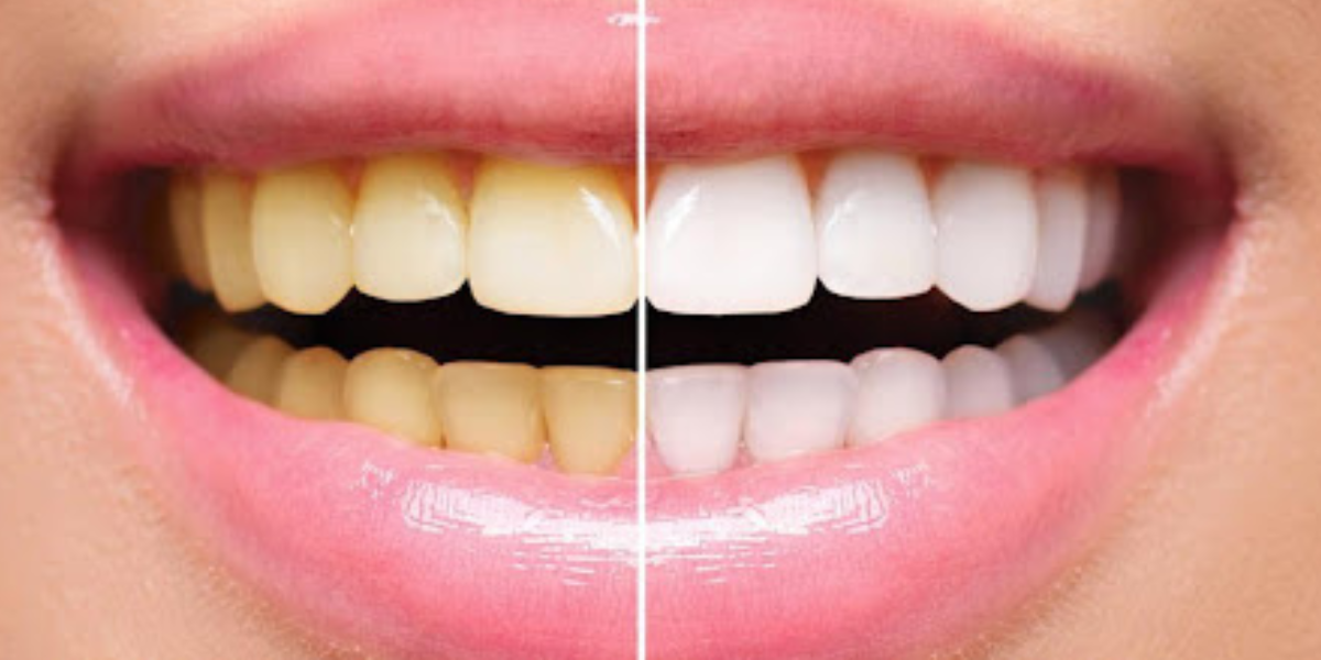 Higiene Bucal Essencial para um Sorriso Mais Branco