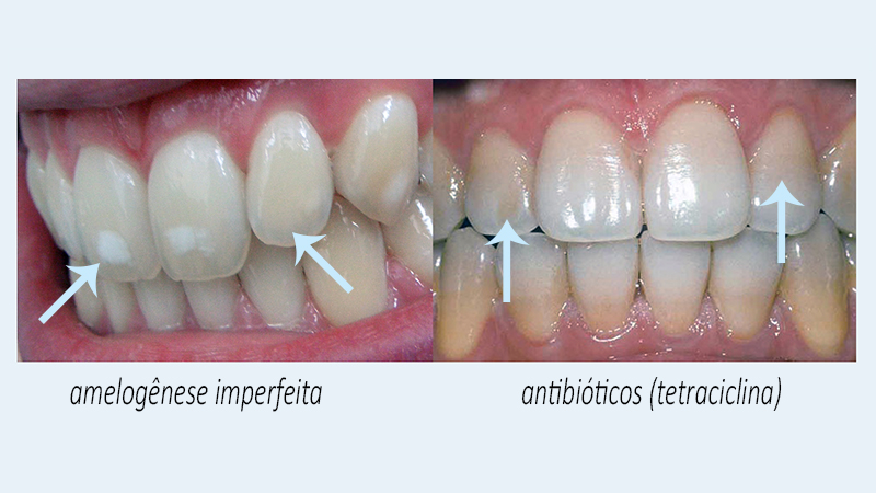 Como clarear os dentes naturalmente
