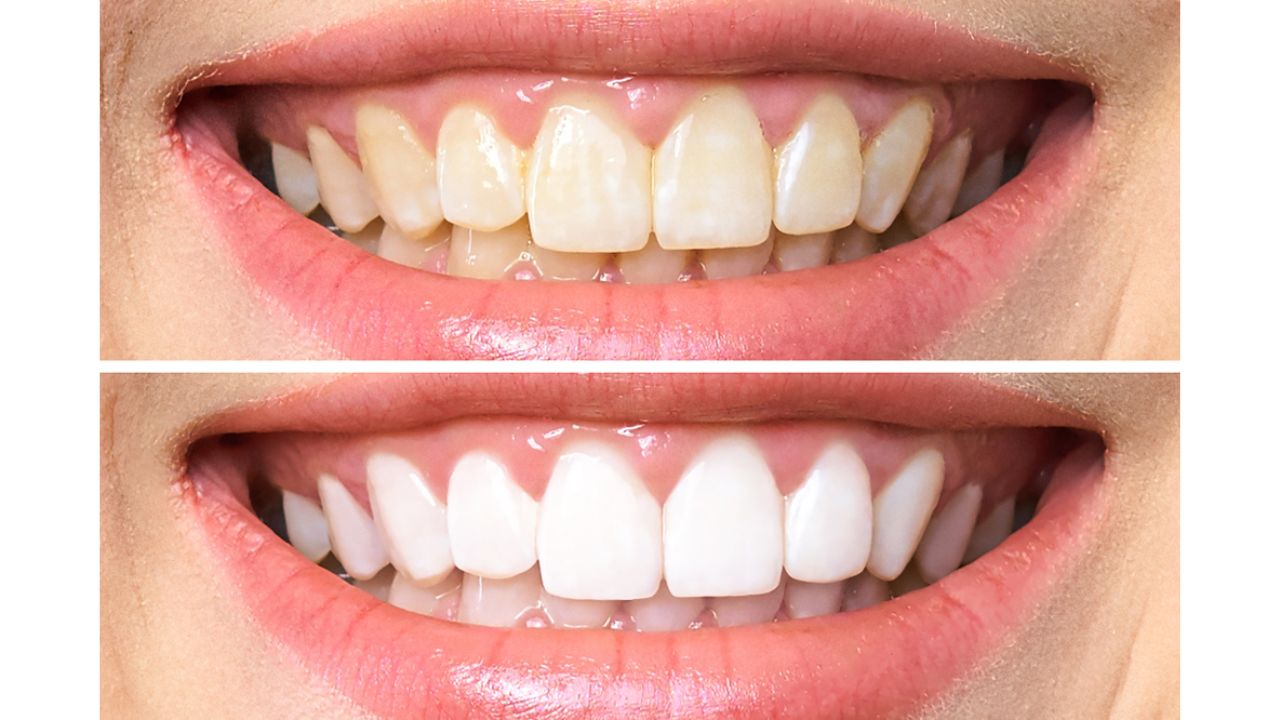 5 Alimentos que Ajudam a Clarear os Dentes Naturalmente