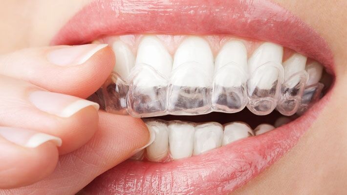 Guia Completo de Clareamento Dental Caseiro