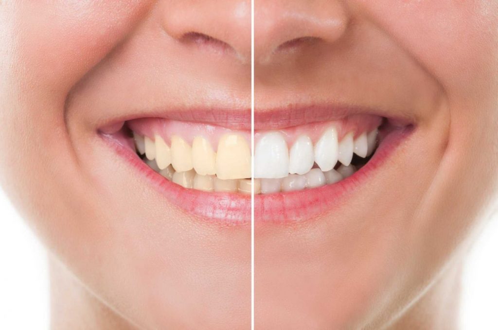 Como Escolher o Melhor Creme Dental para Dentes Sensíveis