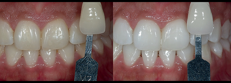 Guia Completo de Clareamento Dental Caseiro