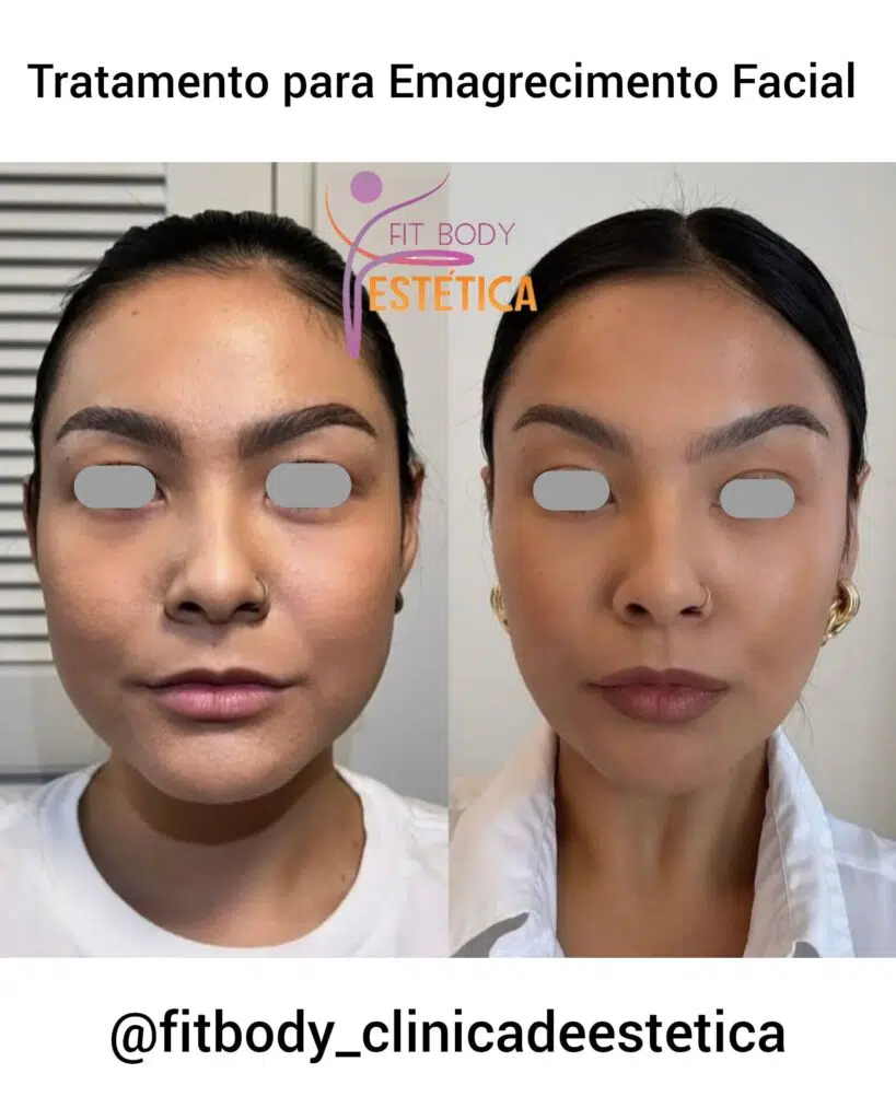 Guia Completo de Procedimentos Estéticos para Afinar o Rosto