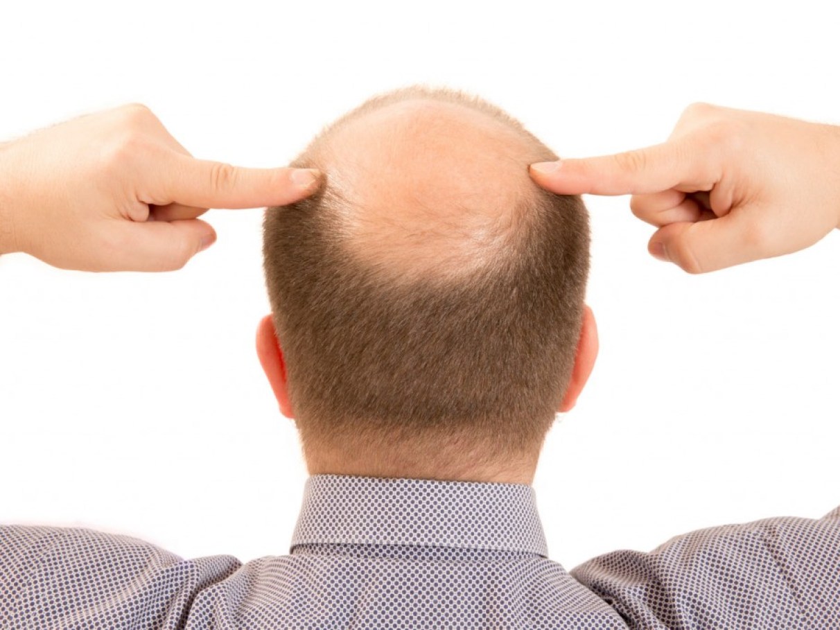 Guia completo de Minoxidil para crescimento capilar