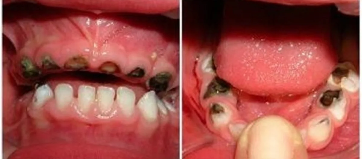 Como escolher a escova de dentes ideal para bebês