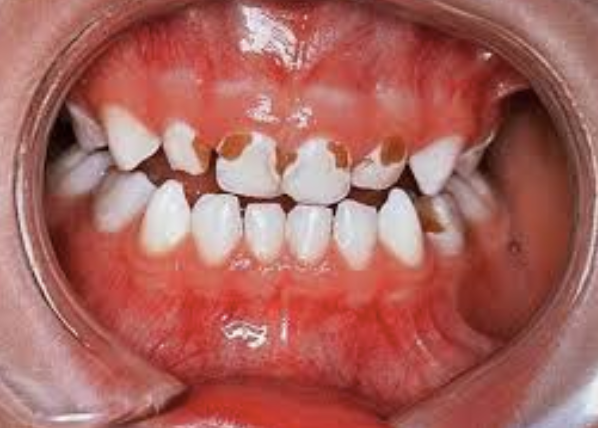 A importância do flúor na prevenção da cárie infantil