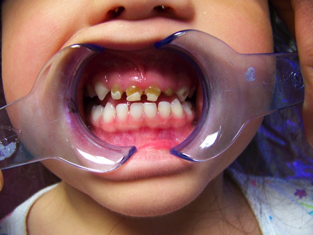 Como escolher a escova de dentes ideal para bebês