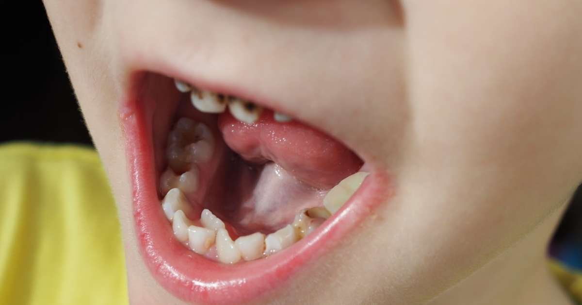 Como evitar a cárie em crianças com necessidades especiais