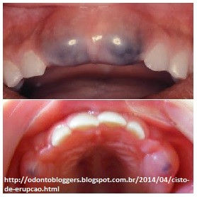 Como adaptar a escovação para crianças com síndrome de Down
