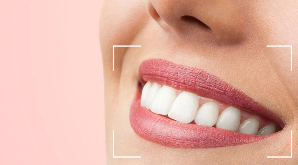 Como evitar a cárie em dentes com facetas de porcelana