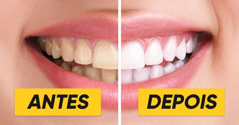 O Que Fazer em Caso de Fratura de uma Faceta Dental?